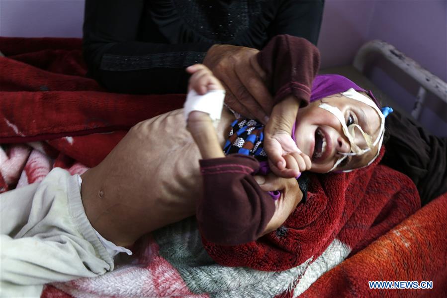 YEMEN-SANAA-CHILDREN-MALNUTRITION