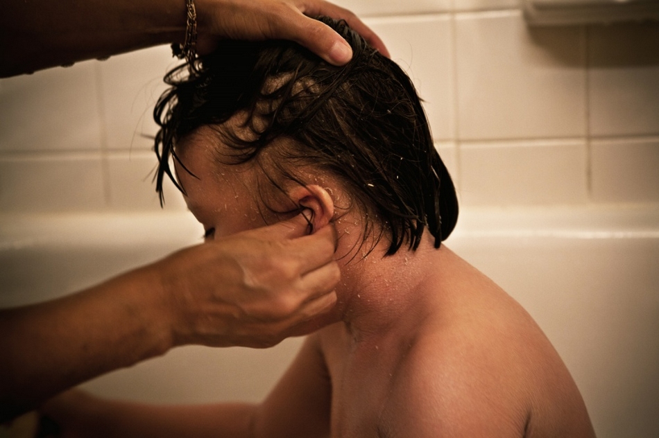 孤兒?。呼~鱗病女孩的艱難生活【圖】