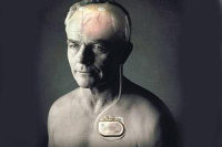 【健康解碼】起搏器真的能治好帕金森病嗎？